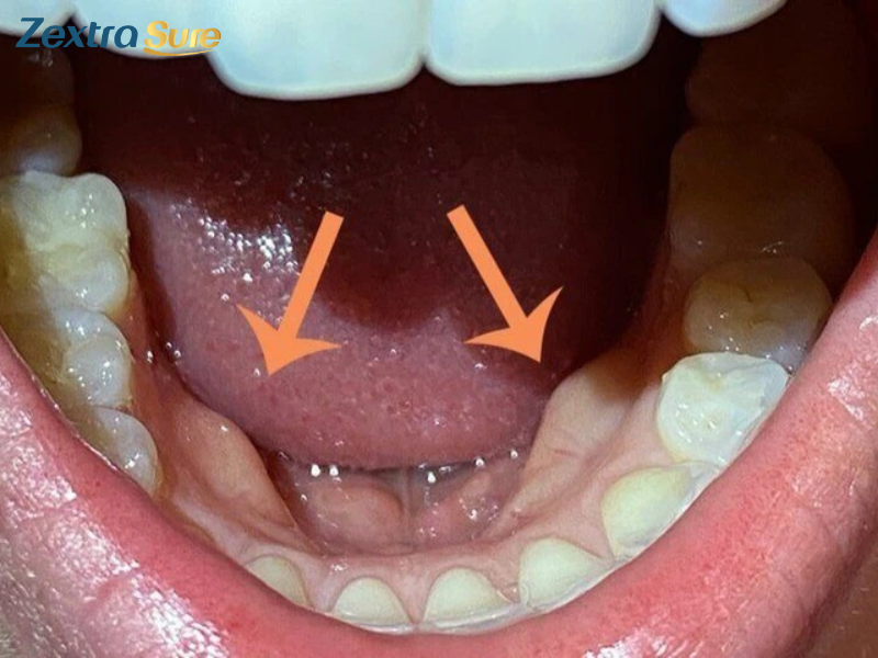 Mandibular-tori-cancer (3)